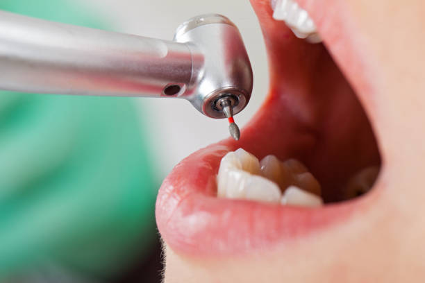 Best Broken or Chipped Tooth Repair in Lake Panasoffkee, FL